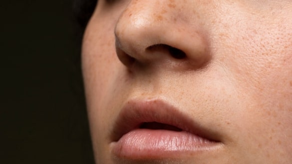 Cara Menghilangkan Flek Hitam di Hidung